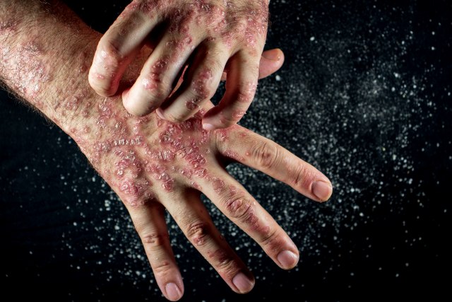 Oboleli pate od stigmatizacije: Da li je psorijaza zarazna?